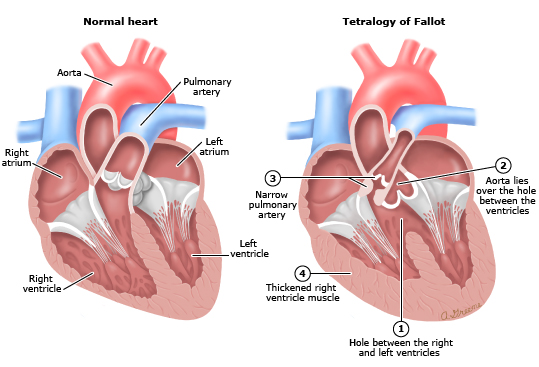 tetrology of fallot term paper tetrology of fallot term paper